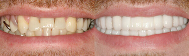 before & after teeth restoration